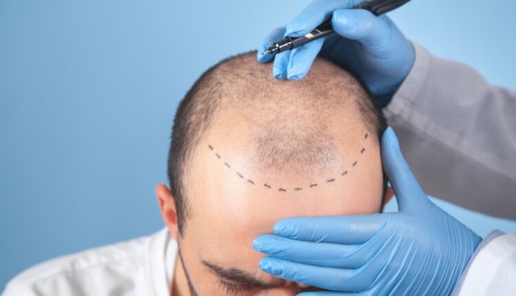 Hair Transplant